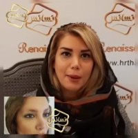 کاشت ابرو - تکنیک جدید کاشت ابرو کلینیک رنسانس