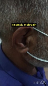 کوچکترین سمعک دنیا