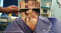 عمل بینی استخوانی توسط دکتر امید ابراهیمی بهترین جراح بینی استخوانی