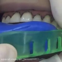 قالب گیری فك بالا جهت ساخت لمینیت و اصلاح طرح لبخند