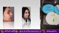 فیلم واقعی جراحی زیبایی بینی استخوانی بعد از 1 سال
