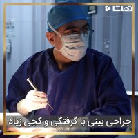 فیلم جراحی بینی کج