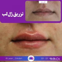 تزریق ژل لب در کلینیک ارکیده