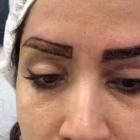 فیلم کاشت ابرو -کلینیک تخصصی رنسانس