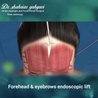 انیمیشن لیفت آندوسکوپی پیشانی و ابرو | دکتر شهریار یحیوی