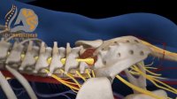 فیلم انیمیشنی تکنیک جراحی سرخوردگی مهره کمر