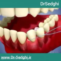 تمیز کردن دندان با بریچینگ