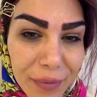 کاشت ابرو | کلینیک تخصصی رنسانس  02122088210