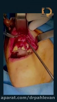 جراحی خارج سازی ضایعه داخل استخوانی فک فوقانی