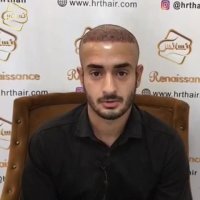 کاشت مو کلینیک تخصصی رنسانس