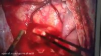 173. فیلم جراحی تومور مغزی در فرد مبتلا به سرطان سینه