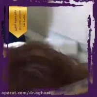 پی آر پی درمانی برای ریزش مو