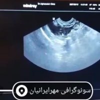 سونوگرافی بارداری داخل رحم و خارج از رحم