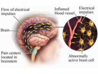 درمان سریع بیماری میگرن در طب مدرن