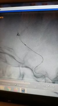 گذاشتن استنت فلودایورتور یا استنت داخل مغزی جهت درمان آنوریسم مغزی