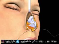 جراحی بینی طبیعی