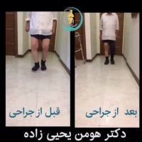 نتیجه عمل جراحی تعویض مفصل زانو