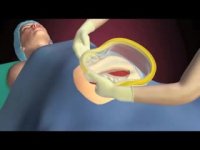 رترکتور شکمی | فروشگاه اینترنتی تجهیزات پزشکی می مد