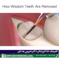 جراحی دندان عقل