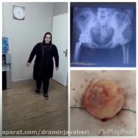 عملیه استبدال مفصل الحوض الیمنی