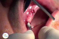 فیلم رضایتمندی جناب آقای ساجدیان بیمار جراحی ایمپلنت دندان