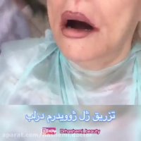 تزریق ژل لب برای فرم دهی و حجم دادن به لب