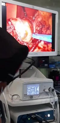 لایو اینستاگرام : جراحی چاقی بای پس در خانم با وزن 132 کیلوگرم