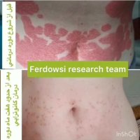 درمان قطعی پسوریازیس