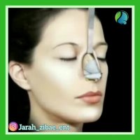 انیمیشن جراحی بینی