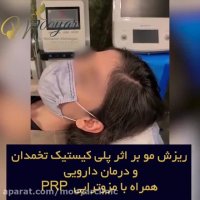 درمان ریزش مو بر اثر پلی کیستیک تخمدان و درمان دارویی و همراه با مزوتراپی