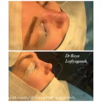 فیلم جراحی بینی گوشتی