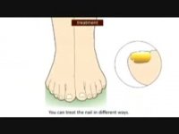 عفونت های قارچی ناخن پا