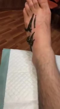 کلینیک زالو درمانی تهران