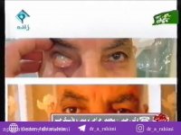 مصاحبه زنده با دكتر ابوالفضل رحیمی - جراحی پیشرفته حدقه
