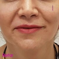 فیلم نتیجه بسیار عالی هایفوتراپی