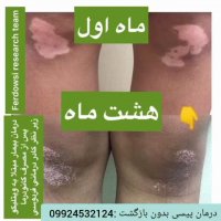 درمان ویتیلیگو