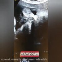 فیلم سونوگرافی صورت جنین دختر