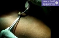 برداشتن و درمان زگیل تناسلی با لیزر در کلینیک اچ پی وی https://hpvdarm