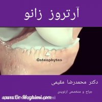 آرتروز زانو