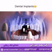ایمپلنت دندان