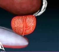 انیمیشن درباره پروستات