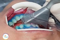 فیلم توضیحات بلیچینگ دندان از زبان دکتر سجودی