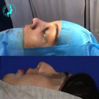 بلافاصله پس از عمل بینی | دکتر گلی