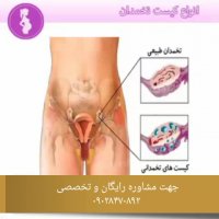 بررسی انواع کیست تخمدان و تاثیر آن بر دستگاه تناسلی و ناباروری زنان
