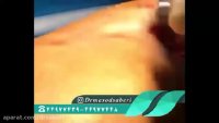 چگونه از تاندون های خود بیمار برای رباط صلیبی استفاده می شود؟
