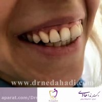 فیلم لمینت کامپوزیتی