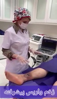 درمان زخم واریس - دکتر فریبا هندسی