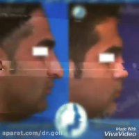 نمونه کار جراحی بینی