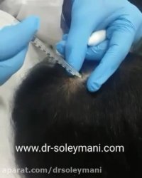 مزوتراپی موی سر