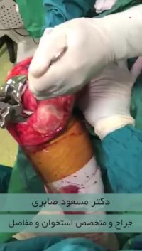 فیلم اصلاح کامل انحراف زانو